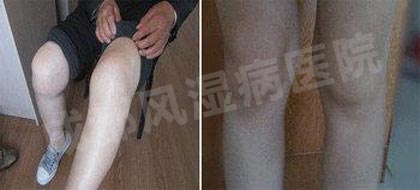 成都风湿医院治疗后患者膝关节症状消失.jpg