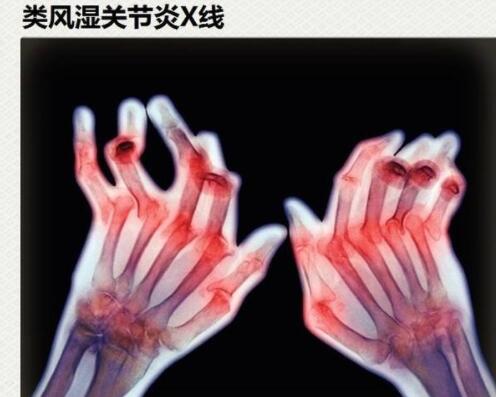 类风湿会引发的并发症有哪些 类风湿会引发的并发症有哪些